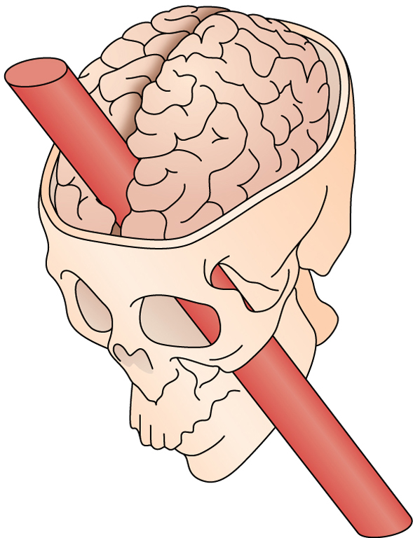 phineas gage case study